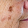 Tratamientos Faciales y para Hiperpigmentaciones